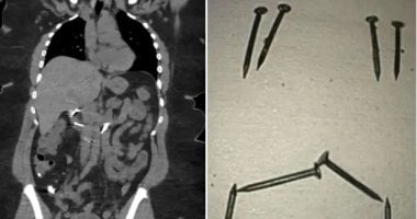 British Woman Undergoes Emergency Surgery After Swallowing Eight Large Nails