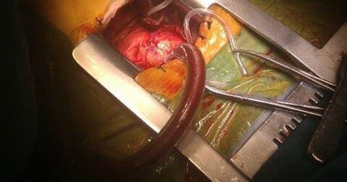 بالصور.. نجاح أول عملية قلب مفتوح بمستشفى جامعة المنصورة