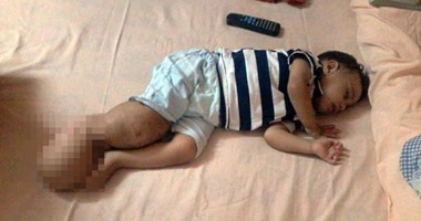 صحافة المواطن.. بالصور.. حالة نادرة لطفل عجز الطب فى مصر عن تشخيصها