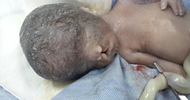 بالصور.. ولادة طفل بدون عيون وبشفة أرنبية وعيوب خلقية بالمخ والعمود الفقرى