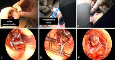 جراحون يستبدلون الصمام الأبهرى دون فتح الصدر بواسطة منظار