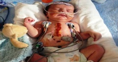 بالصور.. 3 عمليات جراحية خطرة لإنقاذ طفل أمريكى مولود بـ"نصف قلب"