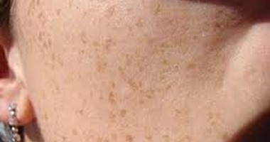 أخصائية جلدية تحذر: بعض البقع البنية تشير إلى الإصابة بسرطان الجلد