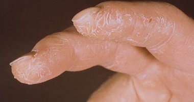 أخصائية جلدية توضح مضاعفات تشقق الأصابع وطرق علاجها