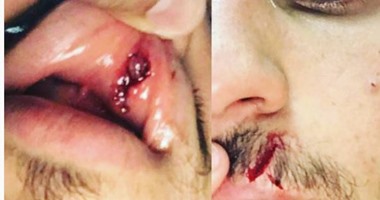 بالفيديو..حجازى يكشف عن إصابته القوية فى الوجه بمباراة بتروجيت