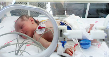 جراحة نادرة لرضيعة عمرها 7 أيام بأنسجة الرئة اليسرى 