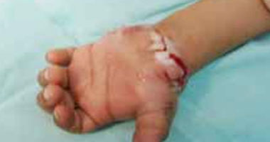 أطباء صينيون ينجحون فى إجراء جراحة لاعادة يد مبتورة لطفل فى السابعة
