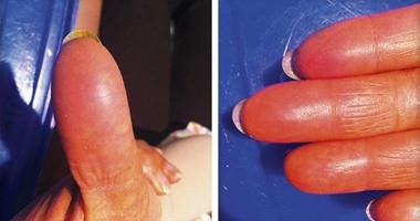 العلاج الكيماوى لسرطان الثدى يمحو بصمات أصابع المرأة