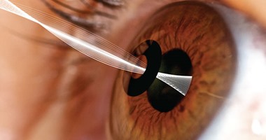 FDA تصدق على أول جهاز يزرع بالعين لعلاج مشاكل الرؤية عن قرب