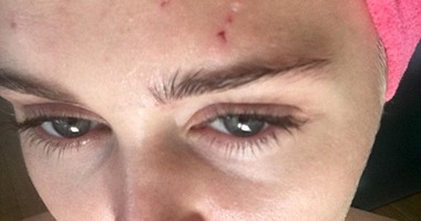 بالصور.. إصابة مايلى سايروس بجروح فى وجهها ورأسها وذراعها بسبب "قطة"