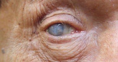 7 أعراض تدل على الإصابة بإعتام العين