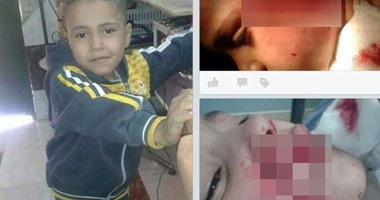 محامى الطفل ضحية كلب الهرم: "محمد معرض للموت ويحتاج السفر للخارج"