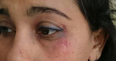 بالصور.. مدير مدرسة يضرب معلمة ويصيبها بجروح لرفضها إعطاء مجموعات خصوصية
