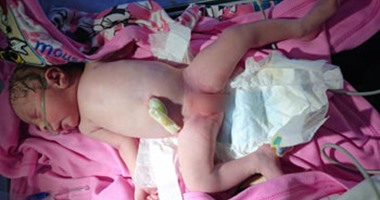 بالصور.. ولادة طفل بأعضاء ذكورية وأنثوية بمستشفى طور سيناء