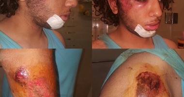 بالصور.. إصابة شاب انقلب بدراجته البخارية بسبب بالوعة مفتوحة فى الرحاب