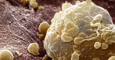 ثورة جديدة فى علاج السرطان تنهى عصر الكيماوى خلال 5 سنوات