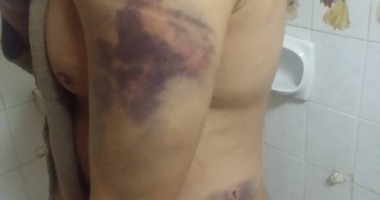 "اليوم السابع" يرصد آثار تعذيب مواطن عربى فى بلغاريا
