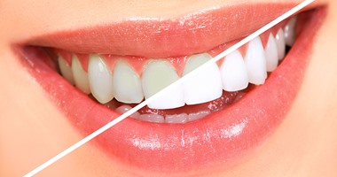 نصائح للتخلص من جير الأسنان
