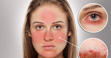 أمراض جلدية تصيب الوجه بسبب حروق الشمس وطرق تفاديها