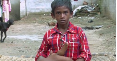 بالفيديو والصور.. مرض نادر يتسبب فى زيادة وزن يد طفل هندى إلى 13 كيلو