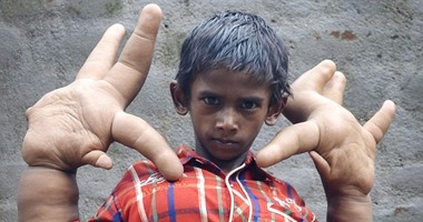  طفل هندى يحصل على لقب صاحب أكبر يدين فى العالم بسبب مرض نادر