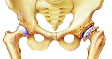 إصابات مفصل الفخذ الأكثر انتشارًا بين كبار السن بسبب هشاشة العظام