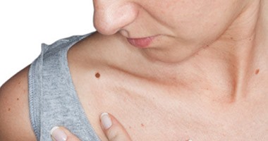 انتبه.. كثرة الشامات علامة على ارتفاع خطر الإصابة بسرطان الجلد