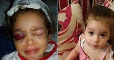 "صحافة المواطن": قارئ يطالب بعلاج طفلة أصيبت برصاصة أدت لكسر جمجمتها