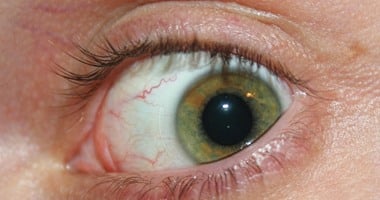 5 أعراض تشير للإصابة بجفاف العين.. الروماتويد والسكر أبرز الأسباب