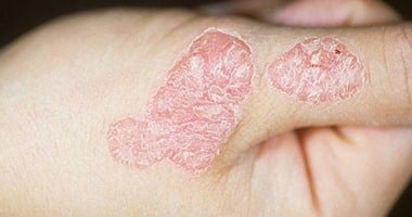 الصدفية أشهر الأمراض الجلدية.. تعرف على أسبابها وأعراضها وأنواعها