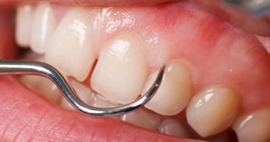 5 علاجات سحرية للتخلص من ألم الأسنان فى المنزل.. أبرزها البصل