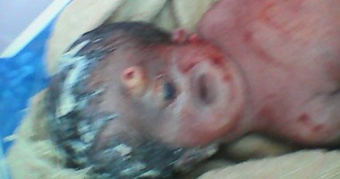 بالصور.. ولادة طفل بعين واحدة وأنف مسمار داخل مستشفى ببنى سويف