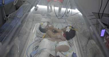 مستشفى الأطفال بجامعة المنصورة يستقبل حالة نادرة لطفلتين ملتصقتين