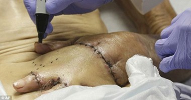 بالصور.. أطباء يثبتون يد عجوز ببطنه لتجنب بترها بعد تعرضه لحادث مروع