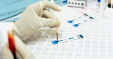 اكتشاف الجين المسئول عن ارتفاع مستوى الكوليسترول فى الدم 