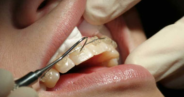 دراسة نرويجية: أضرار حشو الأسنان أكبر من فوائده لأنه يتسبب فى التسوس