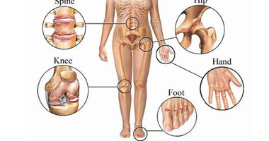 الروماتيزم مش مرض.. دا وصف لآلام الجهاز الحركى بالجسم