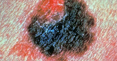 علاج سرطان الجلد عن طريق جهاز المناعة