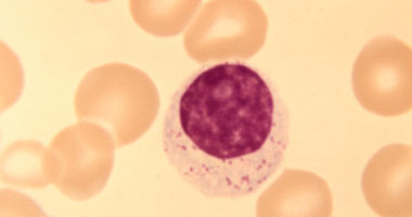 هل نقص خلايا الدم الحمراء يسبب الصداع؟