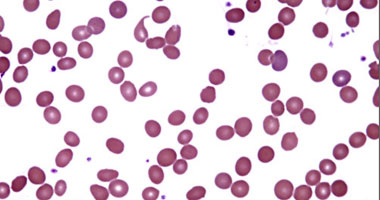 نقل فصيلة دم خاطئة للجسم أهم أسباب التعرض لفقر الدم الانحلالى