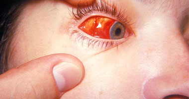 ما علاج التهاب ملتحمة العين