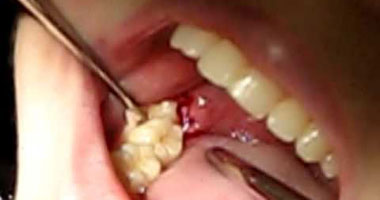   الجراحة الحل الأمثل لعلاج خراج الأسنان 