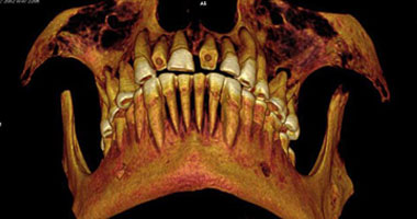 العثور على مومياء مصرية أسنانها محشوة بالكتان لعلاج الآلام