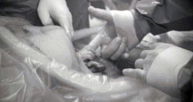 طفلة تتمسك بالحياة أثناء ولادتها