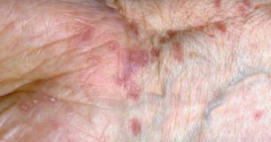 الـ"هيلى - هيلى" مرض جلدى يصيب الإنسان ما بين العشرينات والأربعينات
