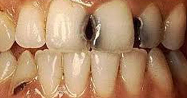 35% من سكان العالم لا يعلمون أنهم يعانون من تسوس الأسنان