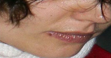 كيف يمكن علاج تقرحات الفم باستخدام الطب البديل 