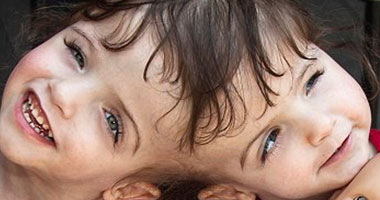 بالصور.. توأمتان تعيشان بجسدين ودماغ واحد