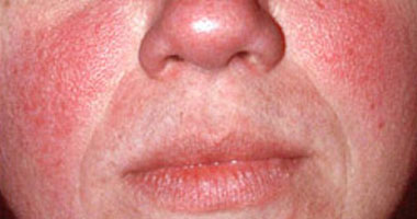 ما ظاهرة التورد التى تحدث للنساء وكيف نواجهها؟ 