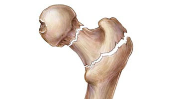 علماء ينجحون فى تطوير فقاعات صغيرة تنفجر داخل العظام لإصلاح الكسور